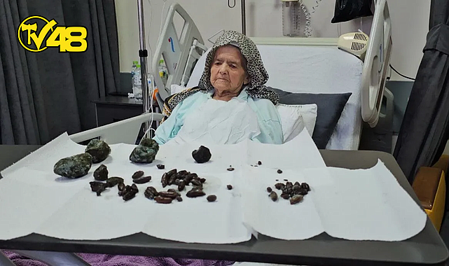MİDESİNDEN 35 ZEYTİN VE 28 HURMA İLE 5 TAŞ ÇIKTI